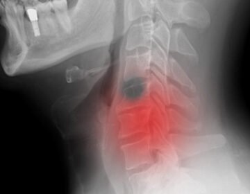 سر اور گردن کے کینسر کی چند عمومی علامات